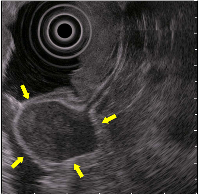 図４超音波内視鏡（矢印でかこった部分が粘膜下腫瘍）