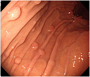 写真２　胃底腺ポリープ