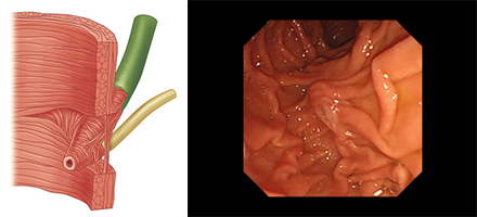 十二指腸乳頭の模式図と内視鏡写真