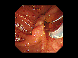 ESTを施行している内視鏡像