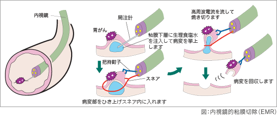 内視鏡的粘膜切除術（EMR）