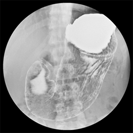 図1. 胃透視検査