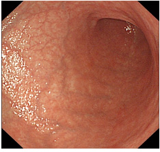 写真２　胃底腺ポリープ