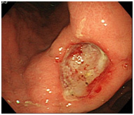 （図１）胃潰瘍