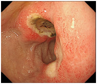 （図２）十二指腸潰瘍