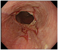 （図４）逆流性食道炎