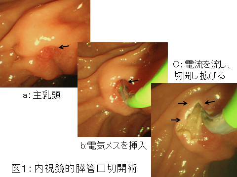 膵臓に石があると言われましたが 手術以外に内視鏡でどうか出来るのですか 日本消化器内視鏡学会 膵臓に石があると言われましたが 手術以外に内視鏡でどうか出来るのですか 日本消化器内視鏡学会