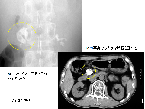 膵臓に石があると言われましたが、手術以外に内視鏡でどうか出来るの 