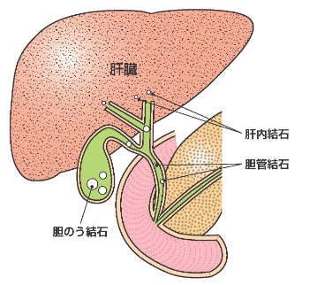 胆石 症 について 正しい の は どれ か